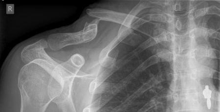 Broken collorbone